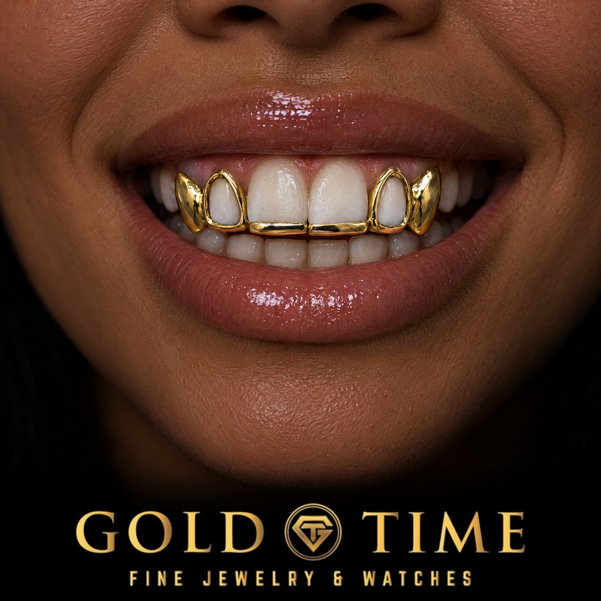 Custom grillz, 6 Piece Solid Tip Bar, Open Face and Solid Canines, worn in a smile, lifestyle photo 2, Gold Time