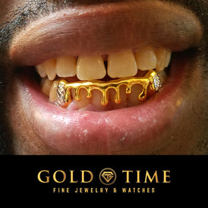 Yellow gold melting drip grillz worn in the mouth, drip running down the front teeth