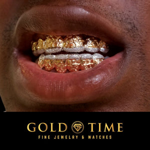 Customer wearing top and bottom custom nugget grillz with diamond dust tips