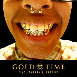Person smiling in two-tone 8 piece grillz with yellow canines and a white drip bottom row