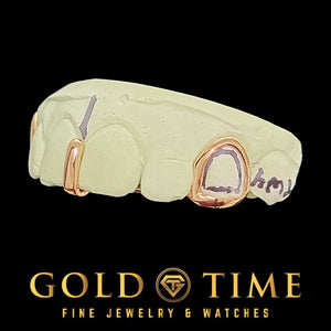 Rose gold open face canine and gap bar pieces on a customer's dental mold
