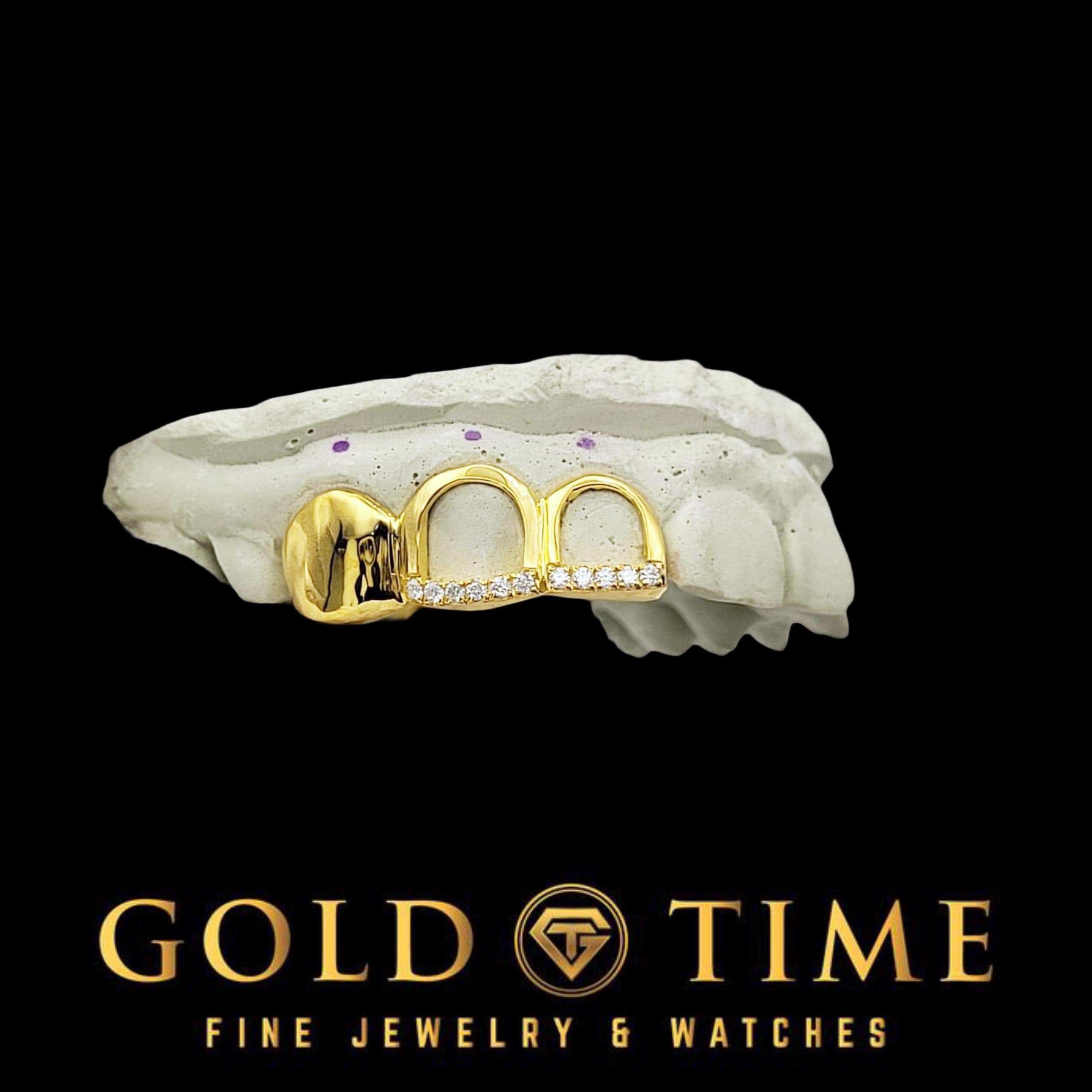 Custom Grillz - Triple Cap with Open Face Moissanite Tips, Solid Cap