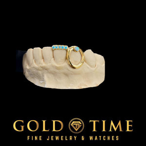 Yellow gold open face canine with a turquoise bezel stone and matching stone tips on a dental model